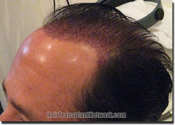 Hair restoration procedure results