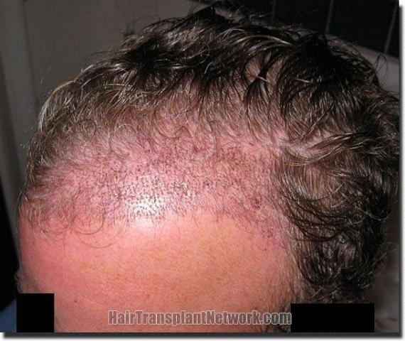 Hair restoration procedure results