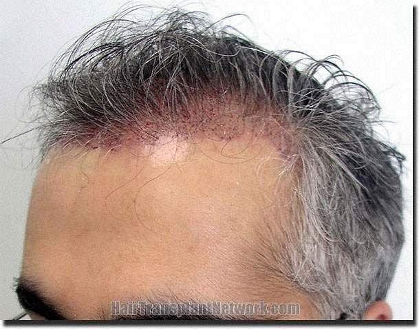 Hair restoration procedure results