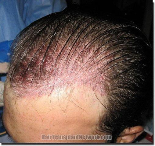 Hair restoration procedure results