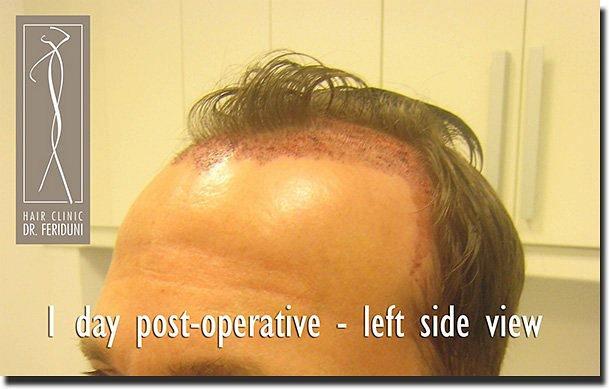 Hair restoration procedure results