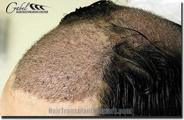 Hair restoration procedure results