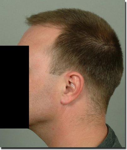 Hair restoration procedure results