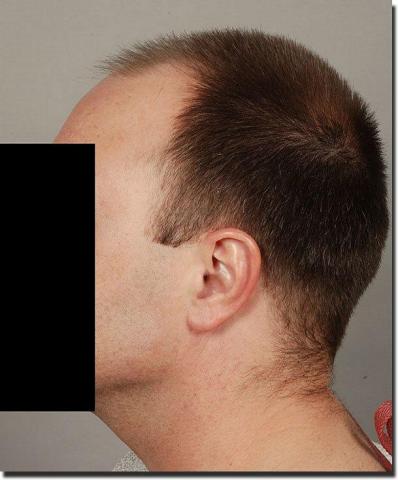 Hair restoration procedure results