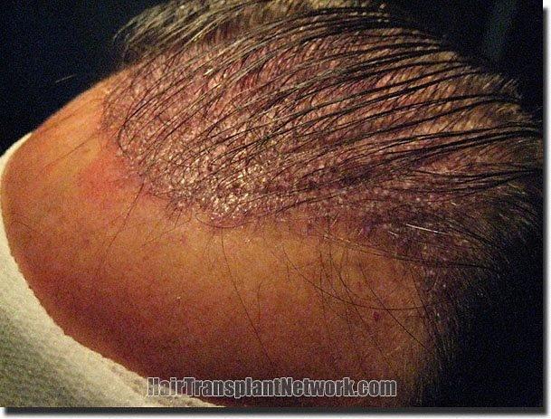 Hair restoration procedure results