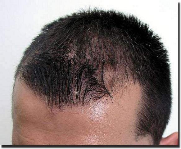 Hair restoration procedure results