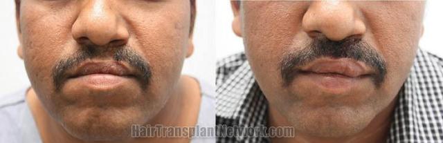 Hair transplantation surgery before and after images