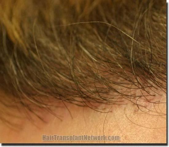 Hair restoration procedure results