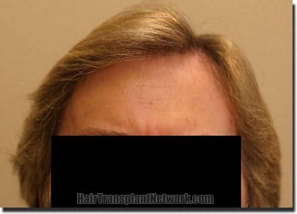 Hair restoration procedure results