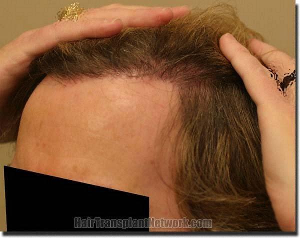 Hair restoration procedure results