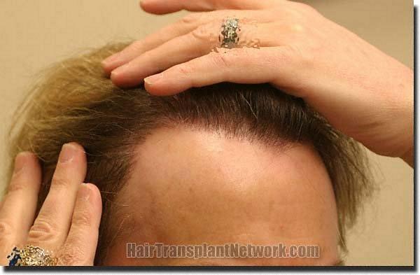 Hair restoration procedure results