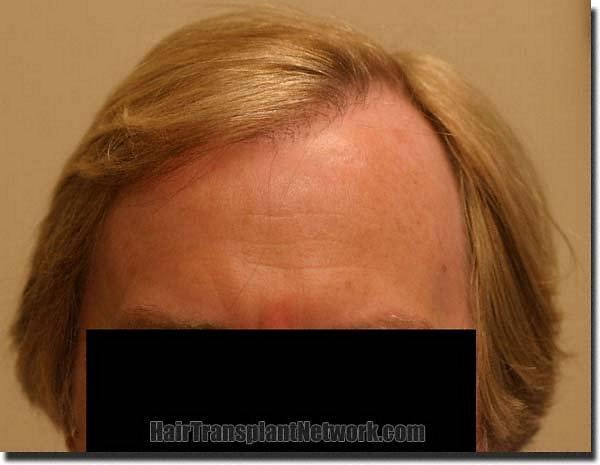 Hair restoration procedure results