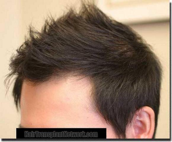 Hair restoration procedure results