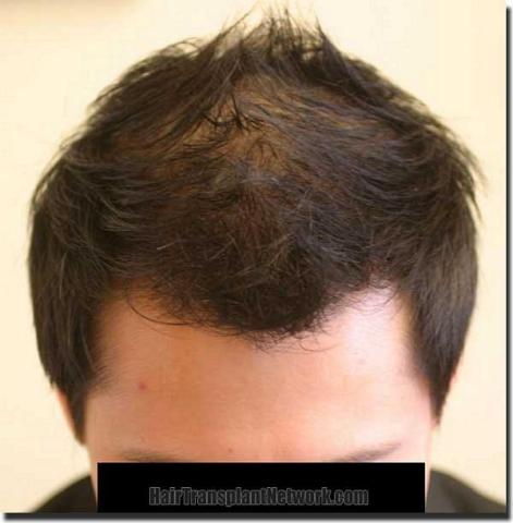 Hair restoration procedure results