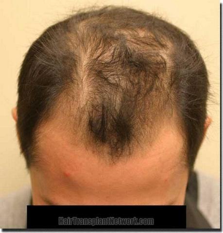 Hair restoration procedure results