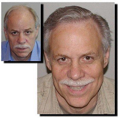 Hair restoration procedure results