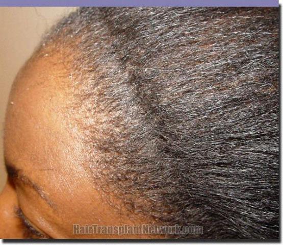 Hair restoration procedure results