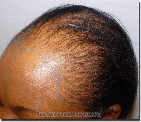 Hair restoration procedure results