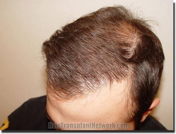 Hair restoration procedure results