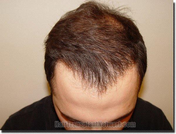 Hair restoration procedure results