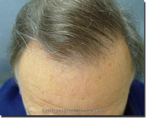 Hair restoration procedure results