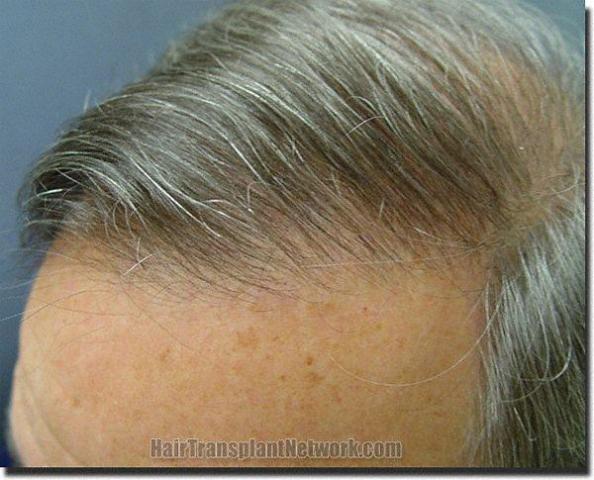 Hair restoration procedure results