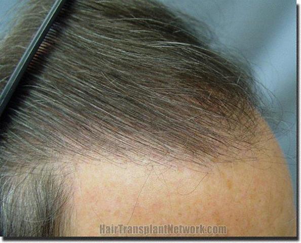 Hair restoration procedure results