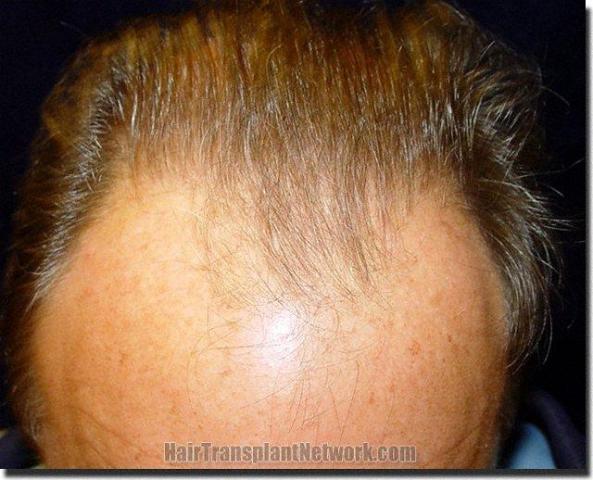 Hair restoration procedure results