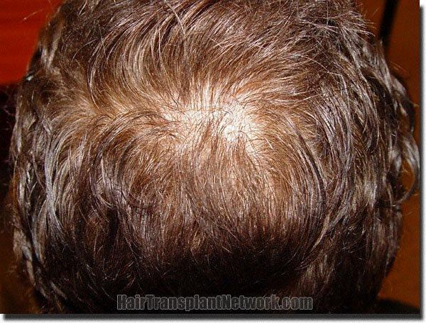 Hair restoration procedure results