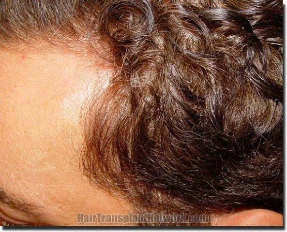 Hair restoration procedure results