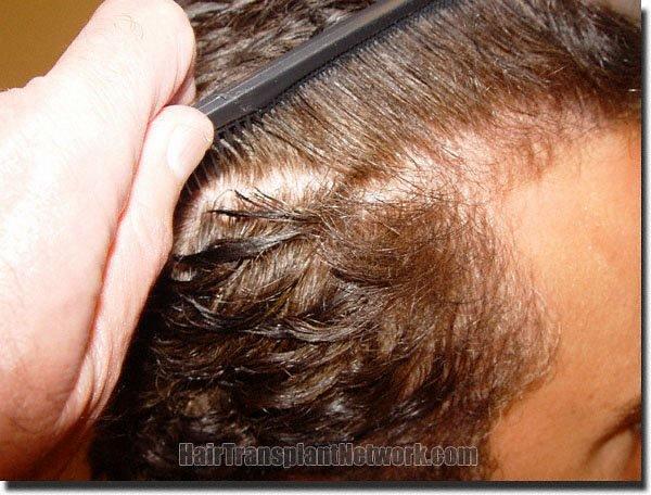 Hair restoration procedure results