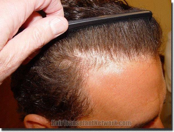 Hair restoration procedure results