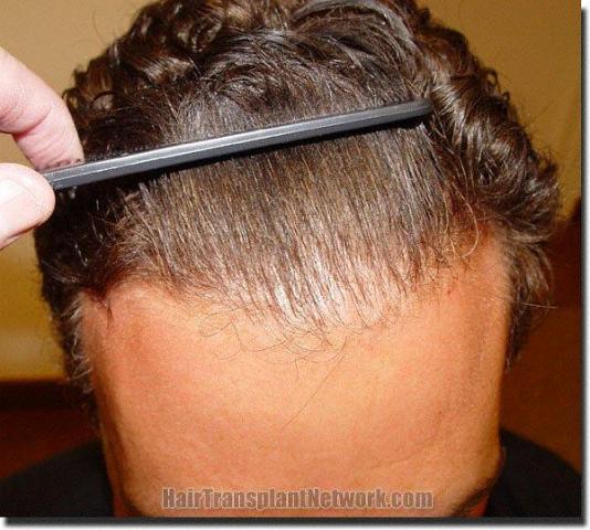 Hair restoration procedure results