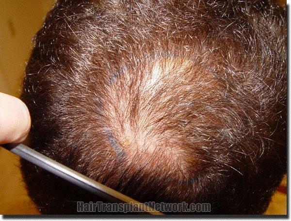 Hair restoration procedure results