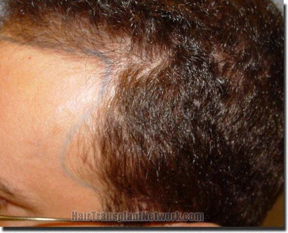 Hair restoration procedure results