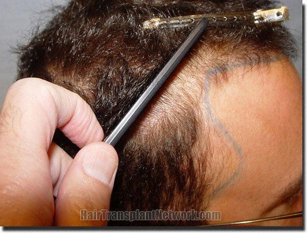 Hair restoration procedure results