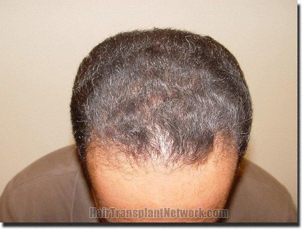 Hair restoration procedure results