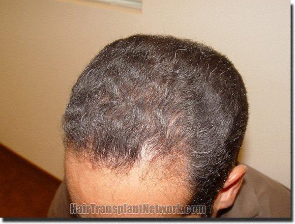 Hair restoration procedure results