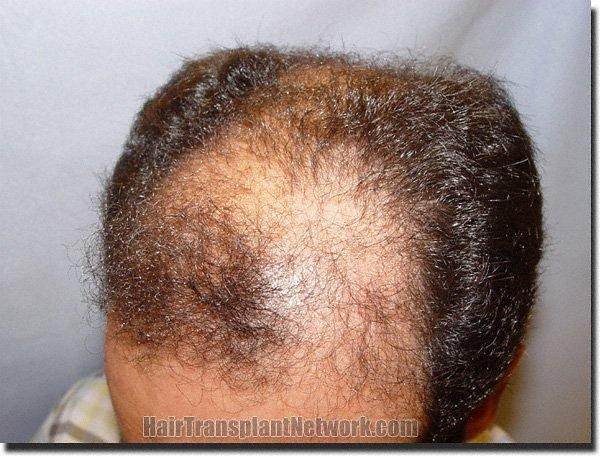 Hair restoration procedure results