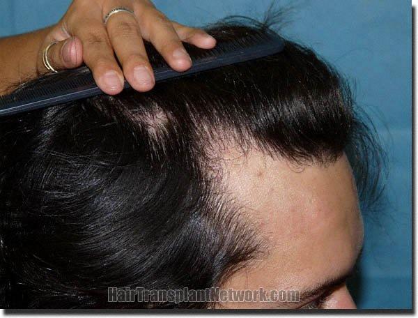 Hair restoration procedure results