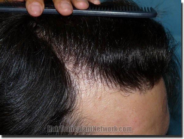 Hair restoration procedure results