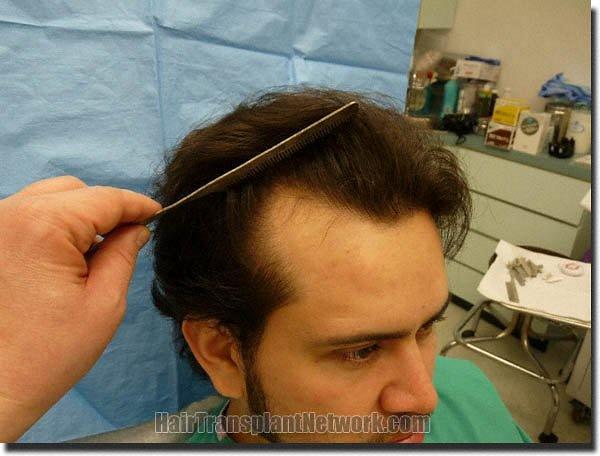 Hair restoration procedure results