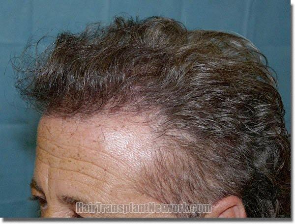 Hair restoration procedure results