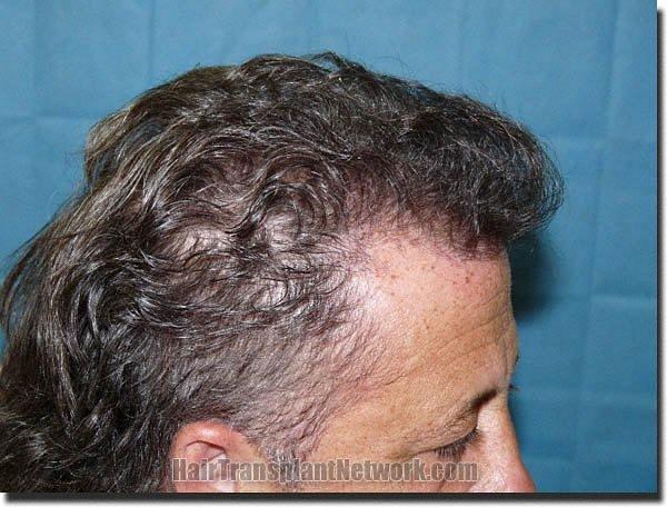 Hair restoration procedure results