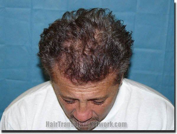 Hair restoration procedure results