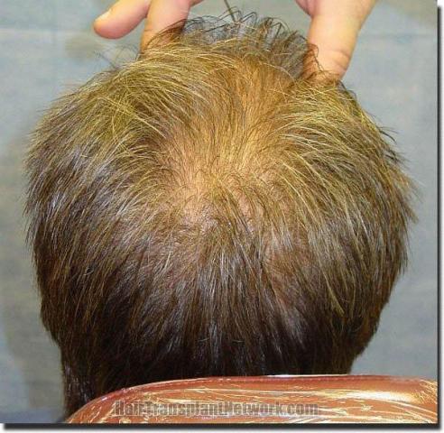 Hair restoration procedure results