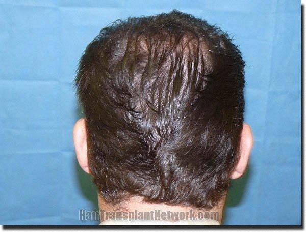 Hair restoration procedure results