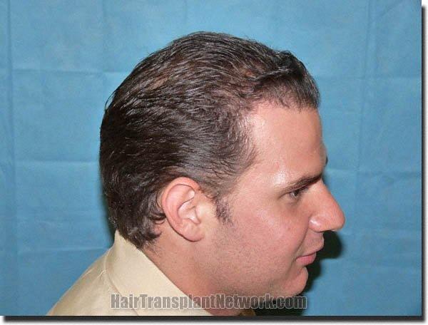 Hair restoration procedure results