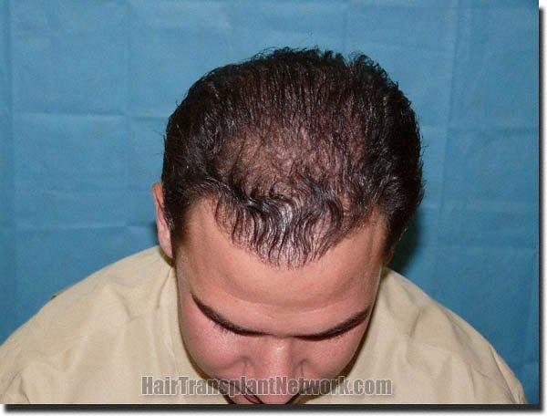 Hair restoration procedure results