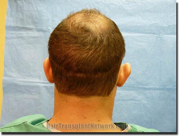 Hair restoration procedure results